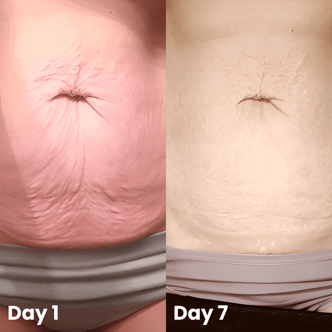 A natural formula that works beautifully without any invasive methods.